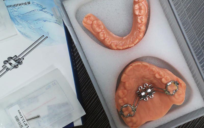 Схватите МСЕ скелетну експанзију уз ВМ Дентал Лаб